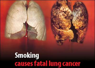 cancro polmoni fumo sigarette