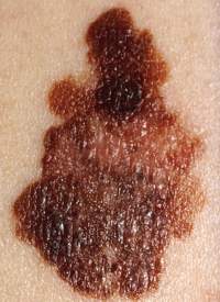 melanoma cancro pelle