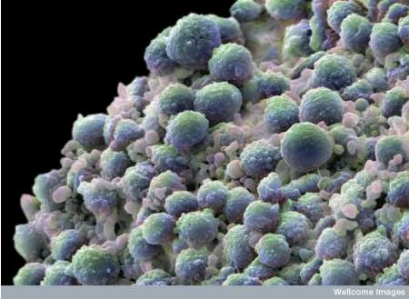 cellule staminali prostata cancro
