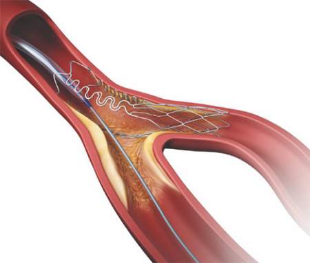 stent arterie coronarie