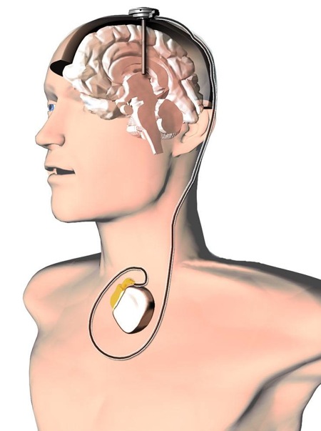 neurostimolazione