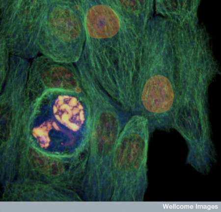 cellula cancro tumore melanoma