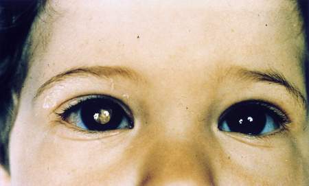 retinoblastoma cancro occhio