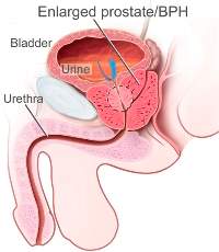 cancro prostata