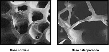osteoporosi ossa