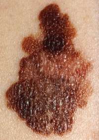 melanoma tumore pelle