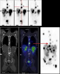 metastasi tumore cancro carcinoma pet
