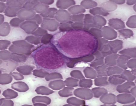 Leukemia