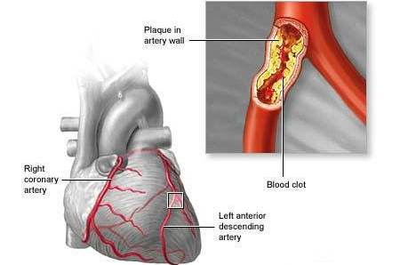 acute coronary syndrome acute coronary syndrome