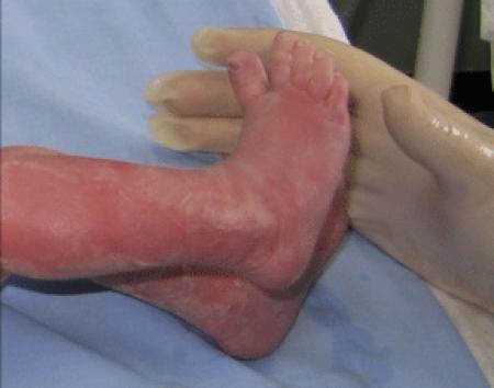 prelievo sangue neonato prelievo sangue neonato