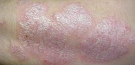 Quanti durare la dermatite atopic