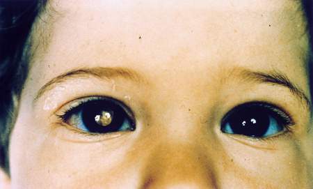 retinoblastoma retinoblastoma