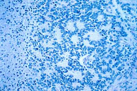 neuroblastoma neuroblastoma