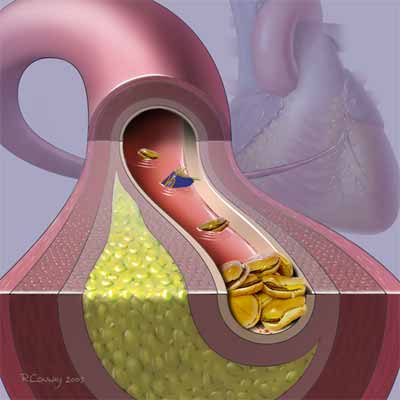 processo di arteriosclerosi