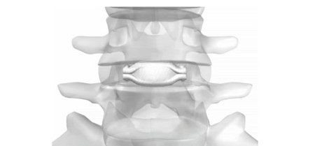 colonna vertebrale protesi disco