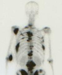 cura metastasi osseo prostata